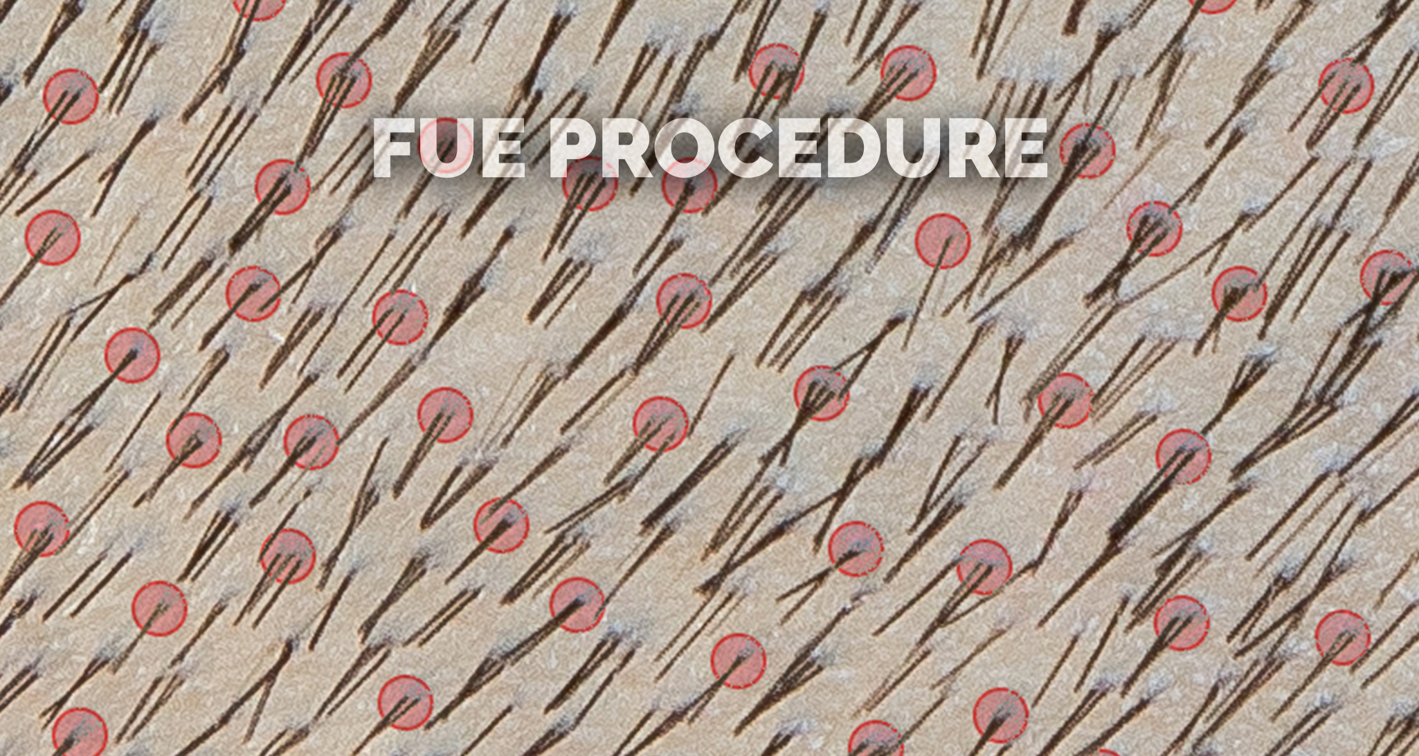 2022-capiland-slide-03-FUE-procedure-2.jpg